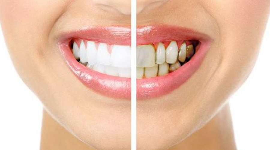 Tratamiento de Periodoncia en guayaquil